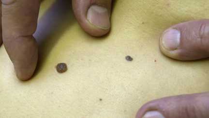 Le vaccin contre le cancer de la peau représente