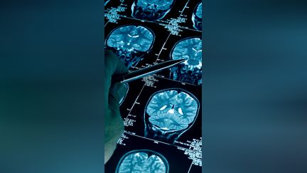 Un cancer sur huit évitable dans le monde