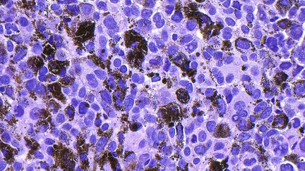 Cancer : le premier vaccin thérapeutique à ARN messager donne de très bon résultats contre le mélanome, le cancer de la peau le plus mortel