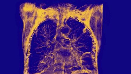 Vaccin contre le mélanome, nouveaux traitements prometteurs... On vous présente les dernières avancées médicales dans la lutte contre le cancer